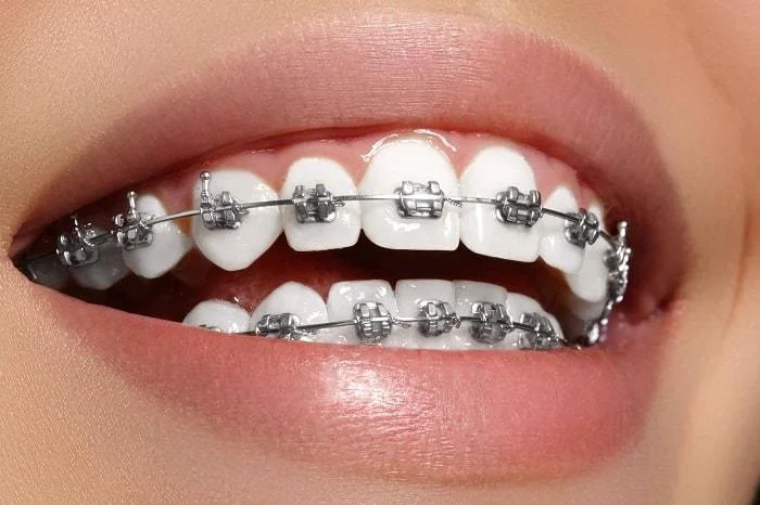 Home dental braces