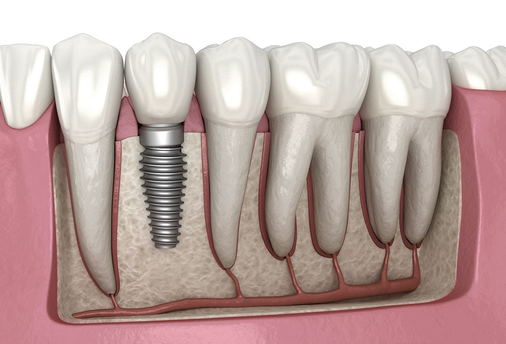 Home dental implant illustration