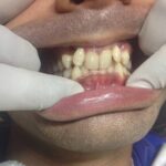 Home smile makeover pre